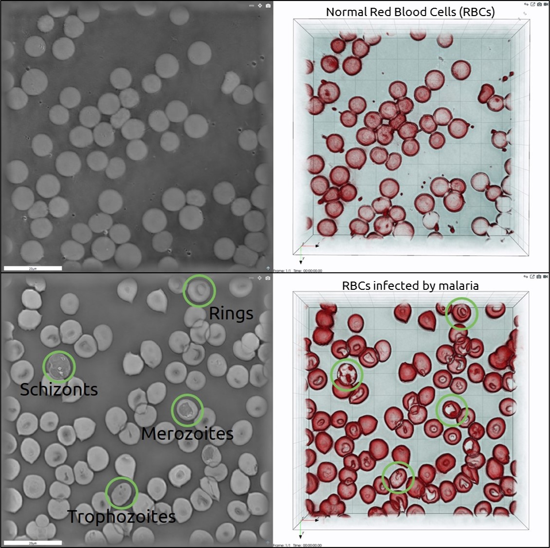 Red Blood Cells: Normal versus Malaria‐infected